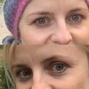 sekret napietej skóry pod okiem